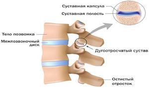 Остеоартроза на ставните стави на гръбначния стълб: колкото по-опасно е заболяването