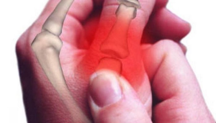 Лечение на артроза на ставите на ръцете: преглед на ефективните методи