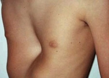 Причини и лечение на образуването на фуния с формата на гърдите
