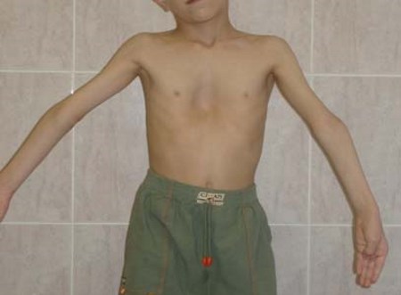 Причини за развитие и начини за премахване на асиметрията на гръдния кош при деца