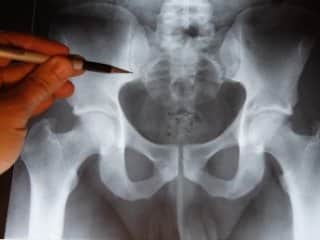 За какво се правят рентгенови лъчи и ултразвук на кокцикса