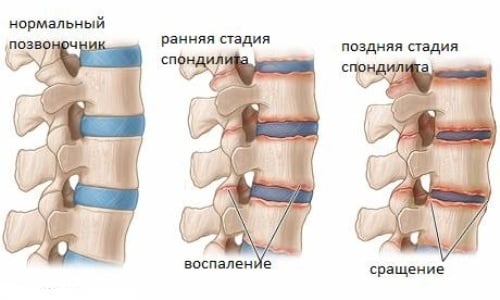 Какво представлява гръбначния спондилит: Причини, симптоми и лечение на патологията