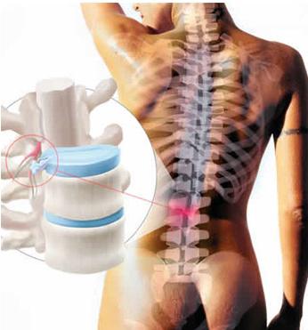 Дегенеративните дистрофични промени в лумбалния гръбнак са