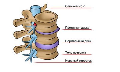 Дискови изпъкналости в лумбалния гръбначен стълб