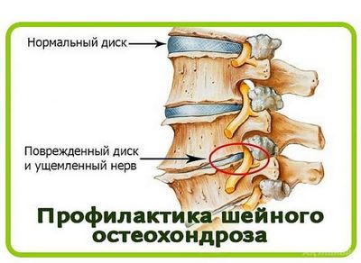 Гимнастика за остеохондроза на лумбалния гръбначен стълб
