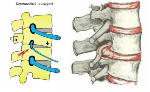 Хернизирани симптоми на лумбалната гръбнака