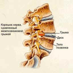 Хернизирани симптоми на лумбалната гръбнака