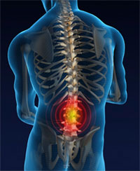 Хернизиран гръбнак на лумбалния гръбнак