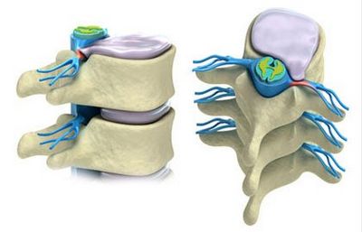 Рехабилитация на лумбалната част на гръбначния стълб на гръбначния стълб