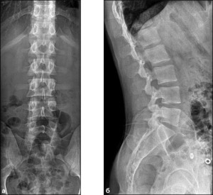 Рентген на гръбначния стълб на лумбосакралния гръбнак