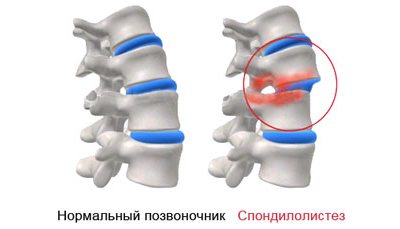 Spondylolisthesis на lumbosacral гръбначния стълб