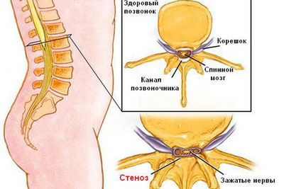 Стеноза на лечението на лумбалния гръбначен канал