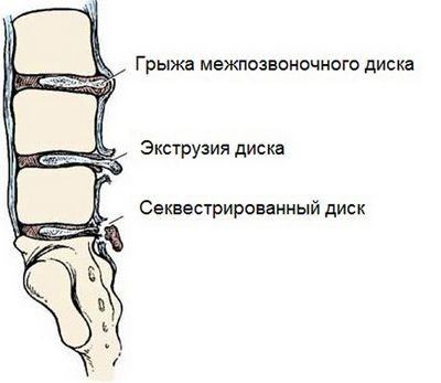Лумбруна на гръбначния стълб на гръбначния стълб l5 s1