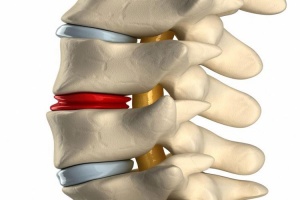 Лумбруна на гръбначния стълб на гръбначния стълб l5 s1