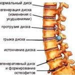 Издаване на гръбначния стълб на гръбнака