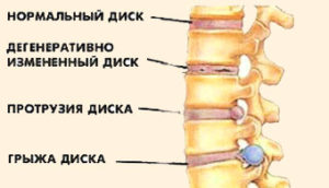 Издаване на гръбначния стълб на гръбнака