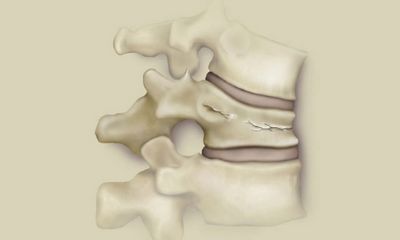 Лечение на гръбначни фрактури на лумбалния гръбначен стълб
