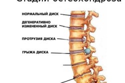 Какви са дегенеративните промени в лумбалната част на гръбначния стълб