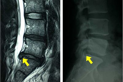 Какво представлява гръбнакът на лумбалната част на гръбначния стълб?