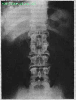 Какво представлява междуребребната остеохондроза на лумбалния гръбначен стълб