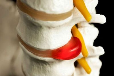 Какво представлява операцията на лумбалния гръбначен стълб?