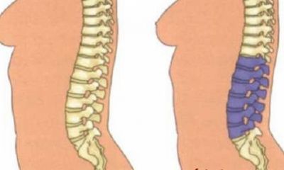 Какво представлява сколиозата на лумбалния гръбначен стълб