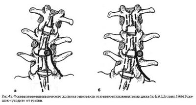 Какво представлява сколиозата на лумбалния гръбначен стълб