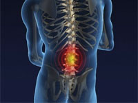 Какво представлява спондилартрозата на лумбосакралния гръбначен стълб?