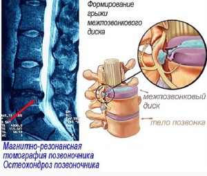 Какво представлява лечението на остеохондрозата на лумбалния регион