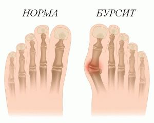 Диагностика и лечение на бурсит на големия пръст