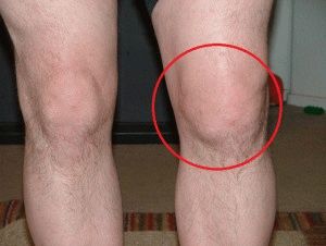 Методи за лечение на подагра на коляното