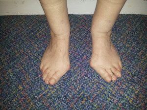 Симптоми и степени на деформиране на артрозата на краката