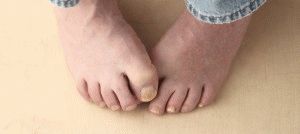 Стартираната форма на гъбичките на краката, ноктите и методите на традиционната медицина