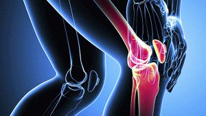 Лечение на деформационна артроза на колянната става и нейната степен