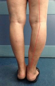 Лечение на деформационна артроза на колянната става и нейната степен