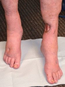 Трофични язви на краката и тяхното лечение