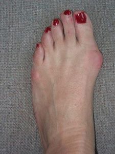 Конуси на крака близо до палеца