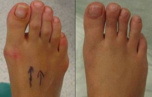 Конуси на крака близо до палеца