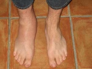 Артроза-артрит на крака