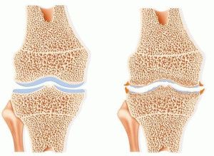 Артроза-артрит на колянната става