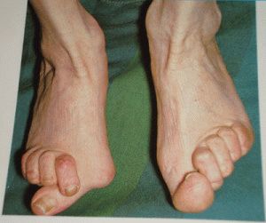 Остеоартрит на пръстите на краката