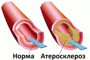 Атеросклероза на долните крайници в напреднала възраст