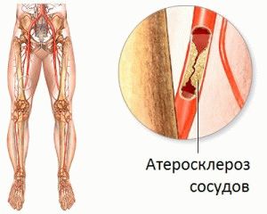 Атеросклероза на долните крайници в напреднала възраст