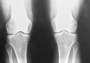 Двустранна артроза на колянната става от 1 градус