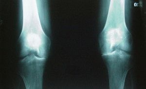 Деформиране на остеоартрита на колянната става