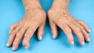 Инвалидност при ревматоиден артрит