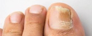 Капки от ноктите на ноктите на краката