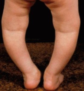 Фактори, допринасящи за развитието на плоски крака