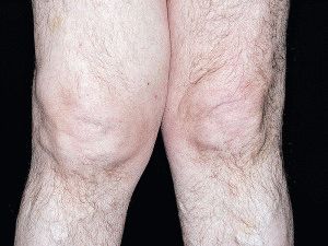 Гонартроза на колянната става от втора степен