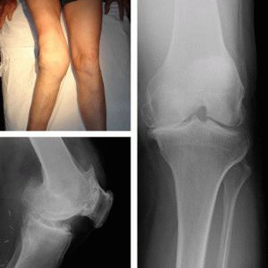 Гонартроза на колянната става от втора степен